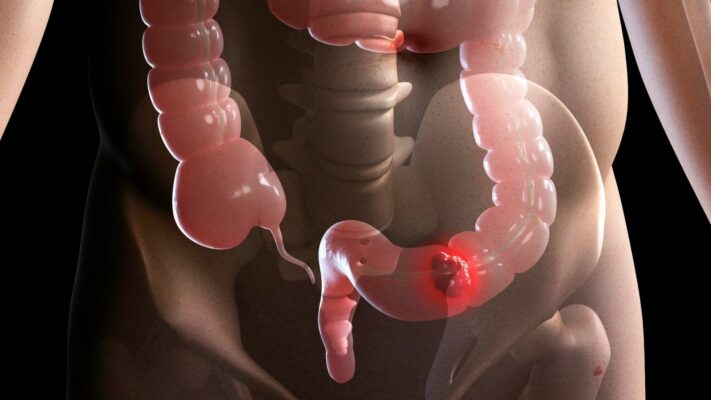 Ankara Reviews from Patients with Rectal Cancer