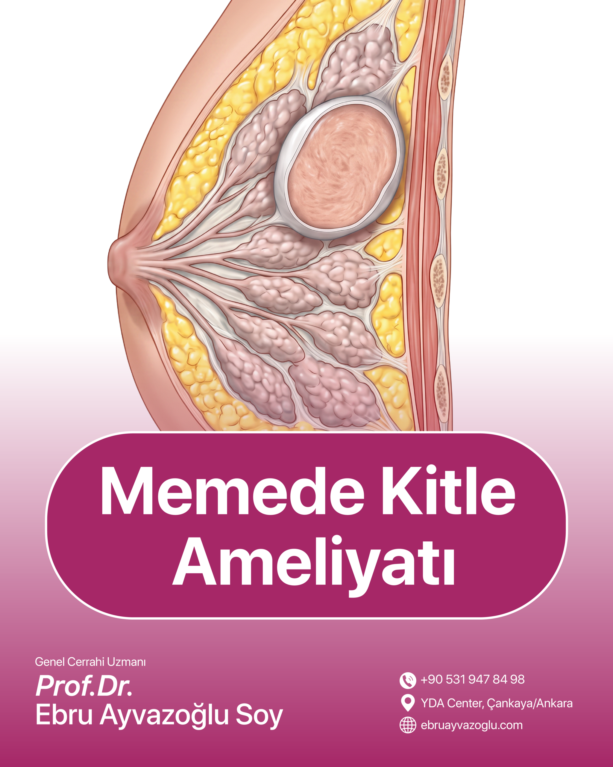 Memede Kitle Ameliyatı