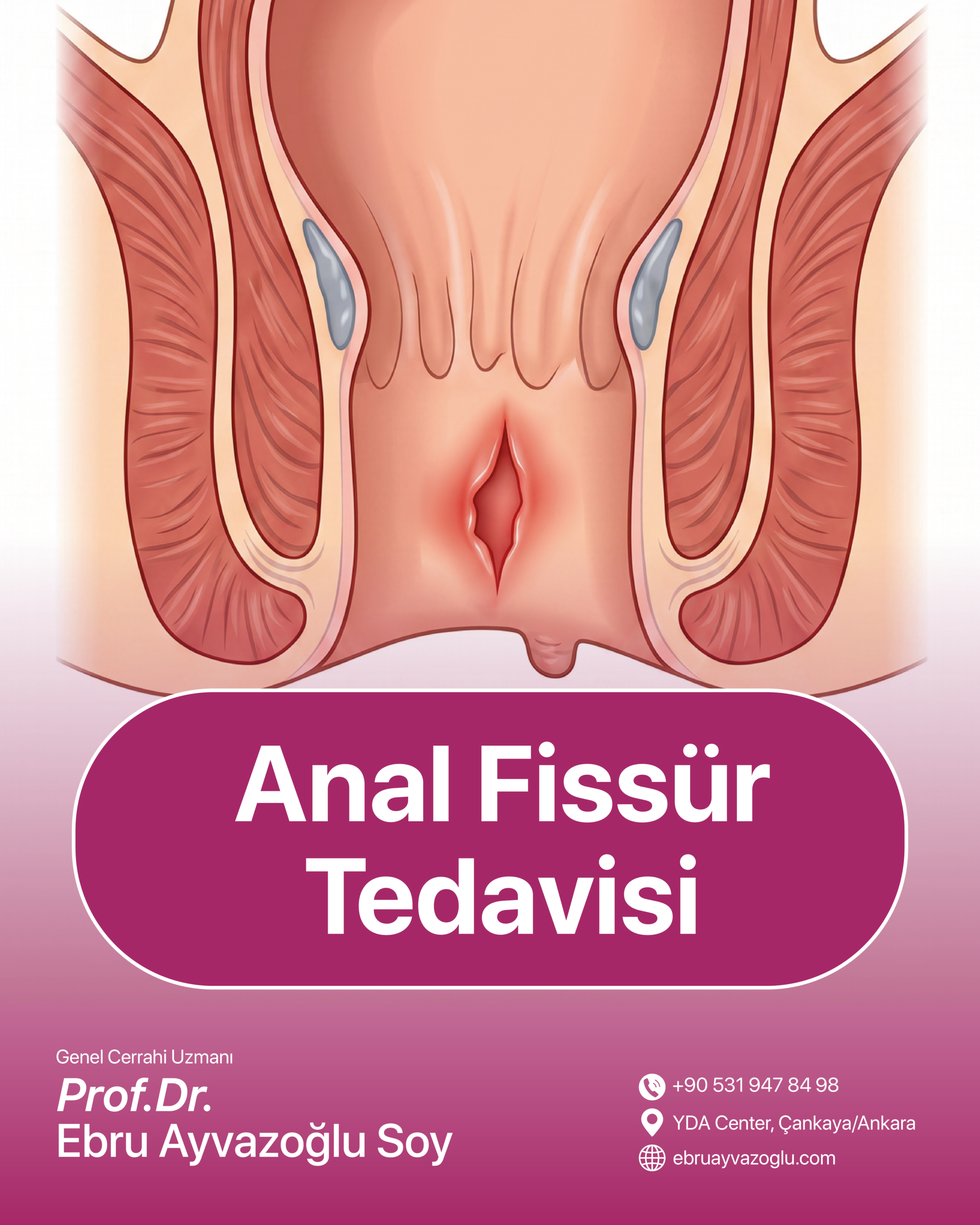 Anal Fissür Tedavisi