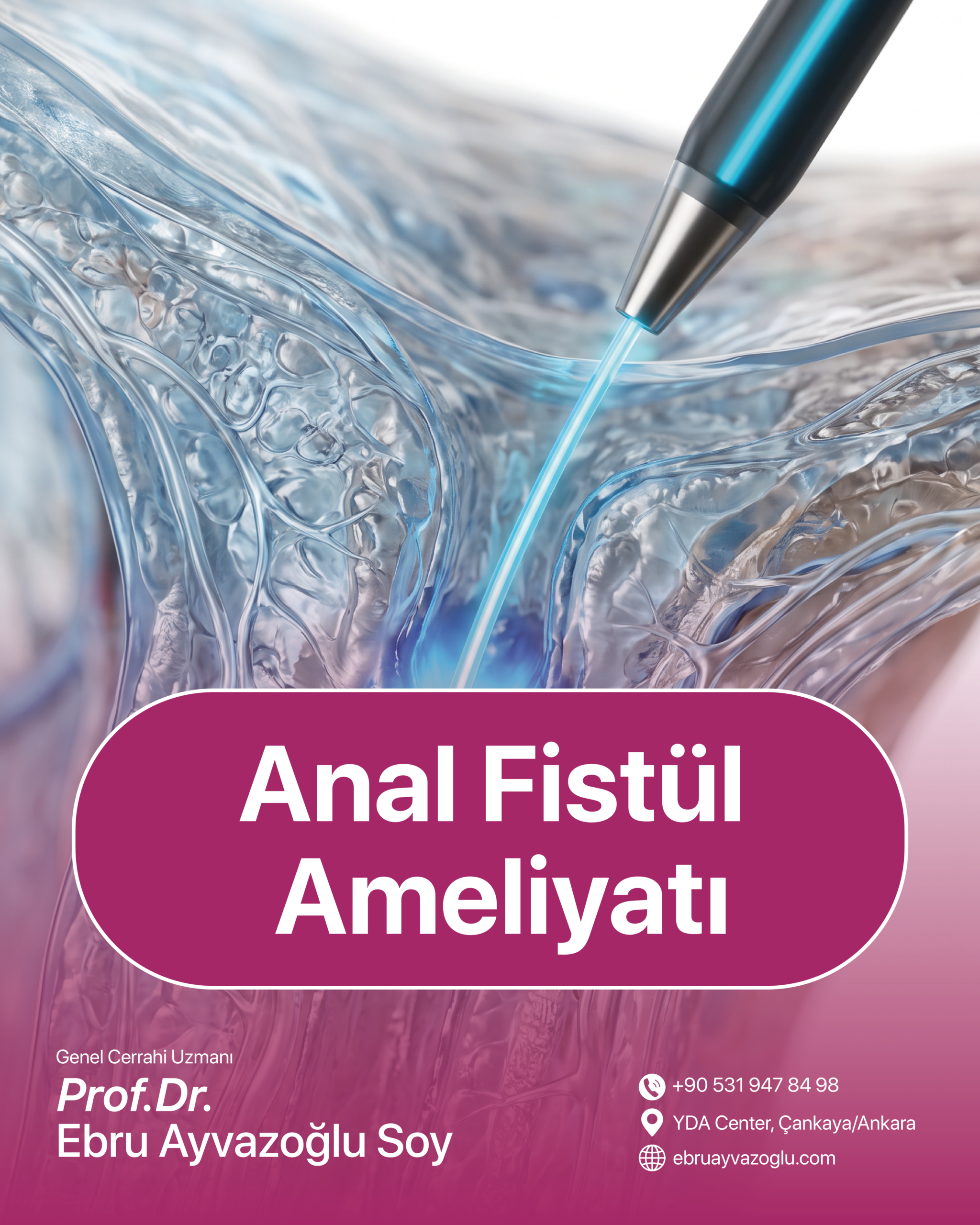 Anal Fistül Ameliyatı