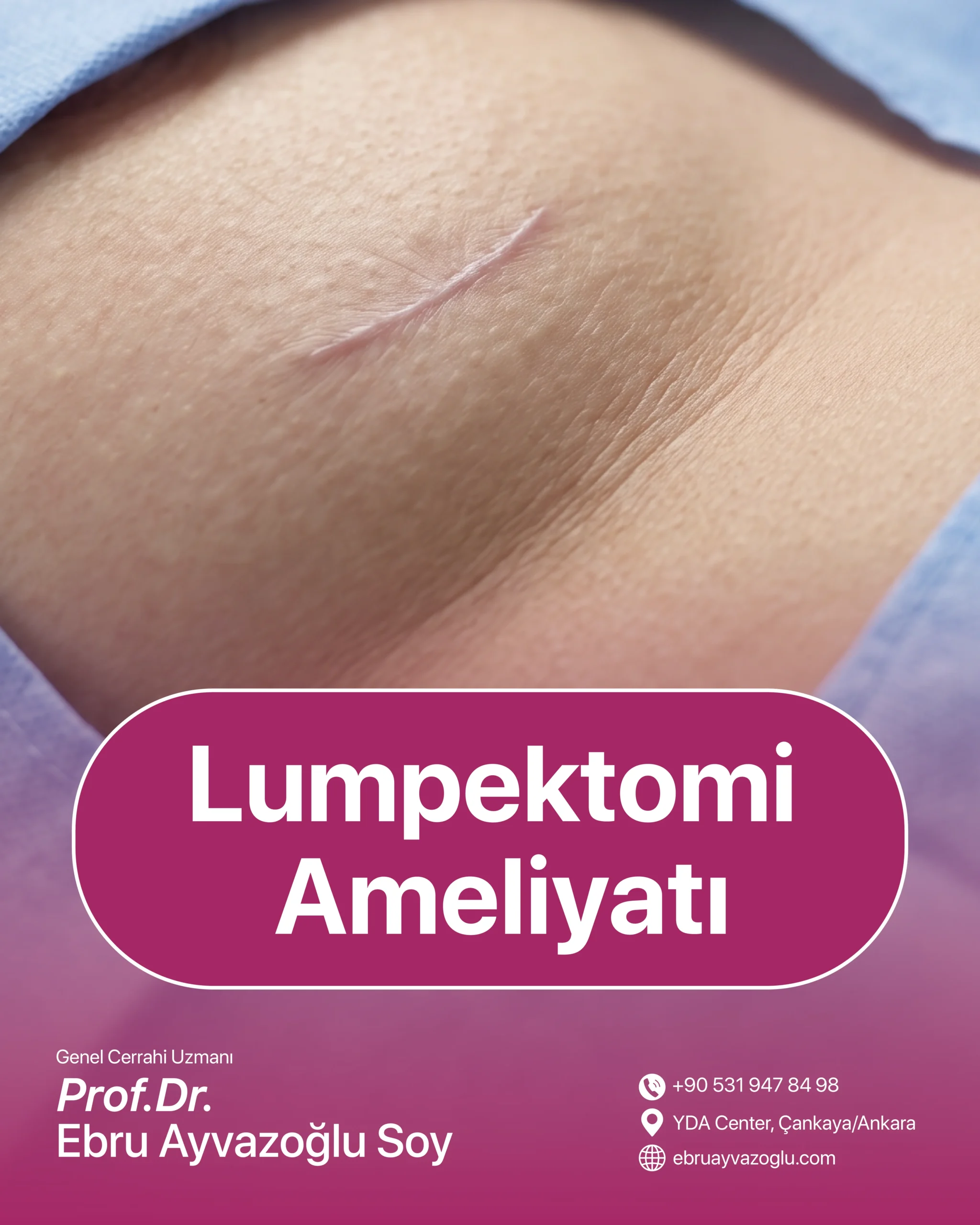 Lumpektomi Ameliyatı