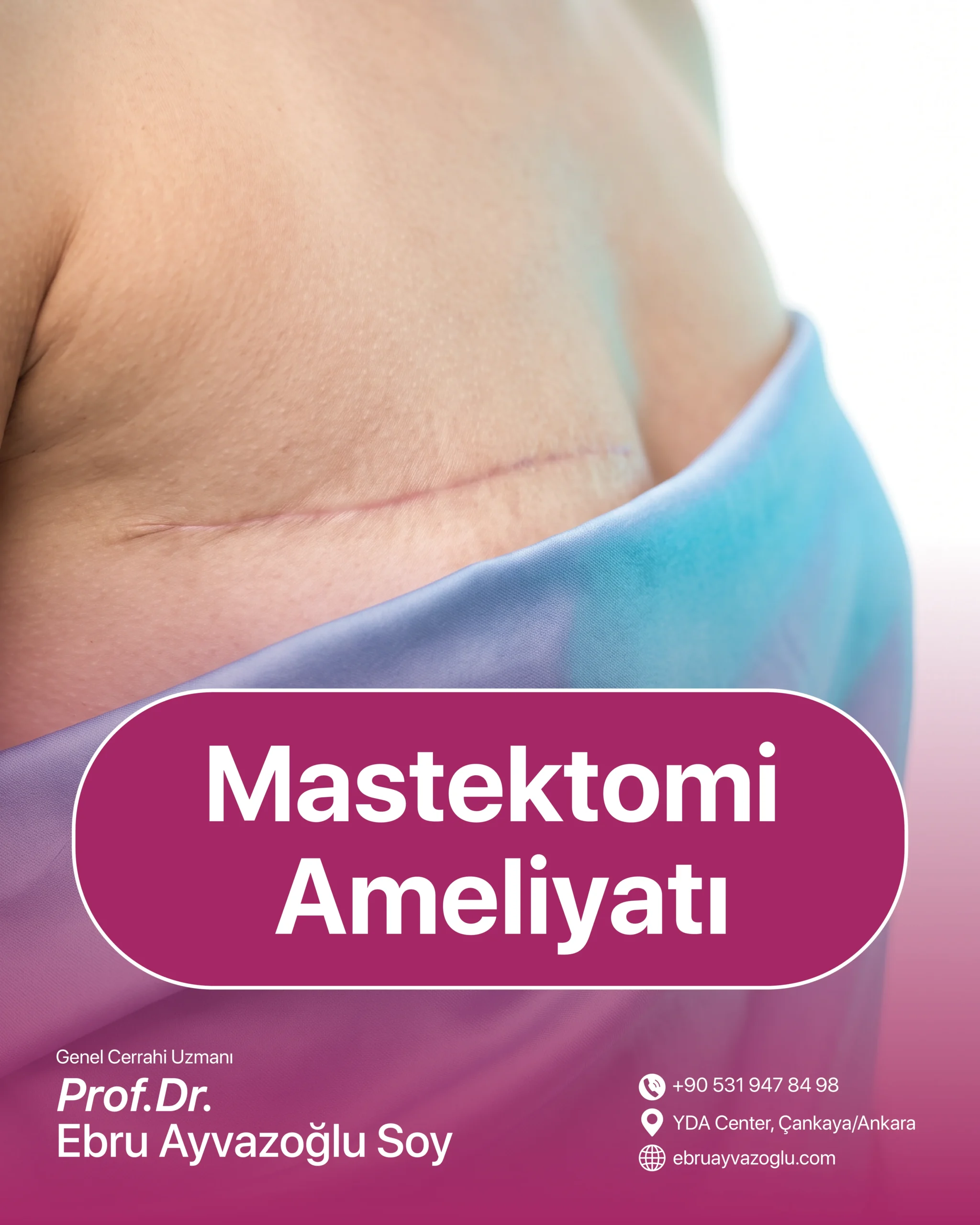 Mastektomi Ameliyatı