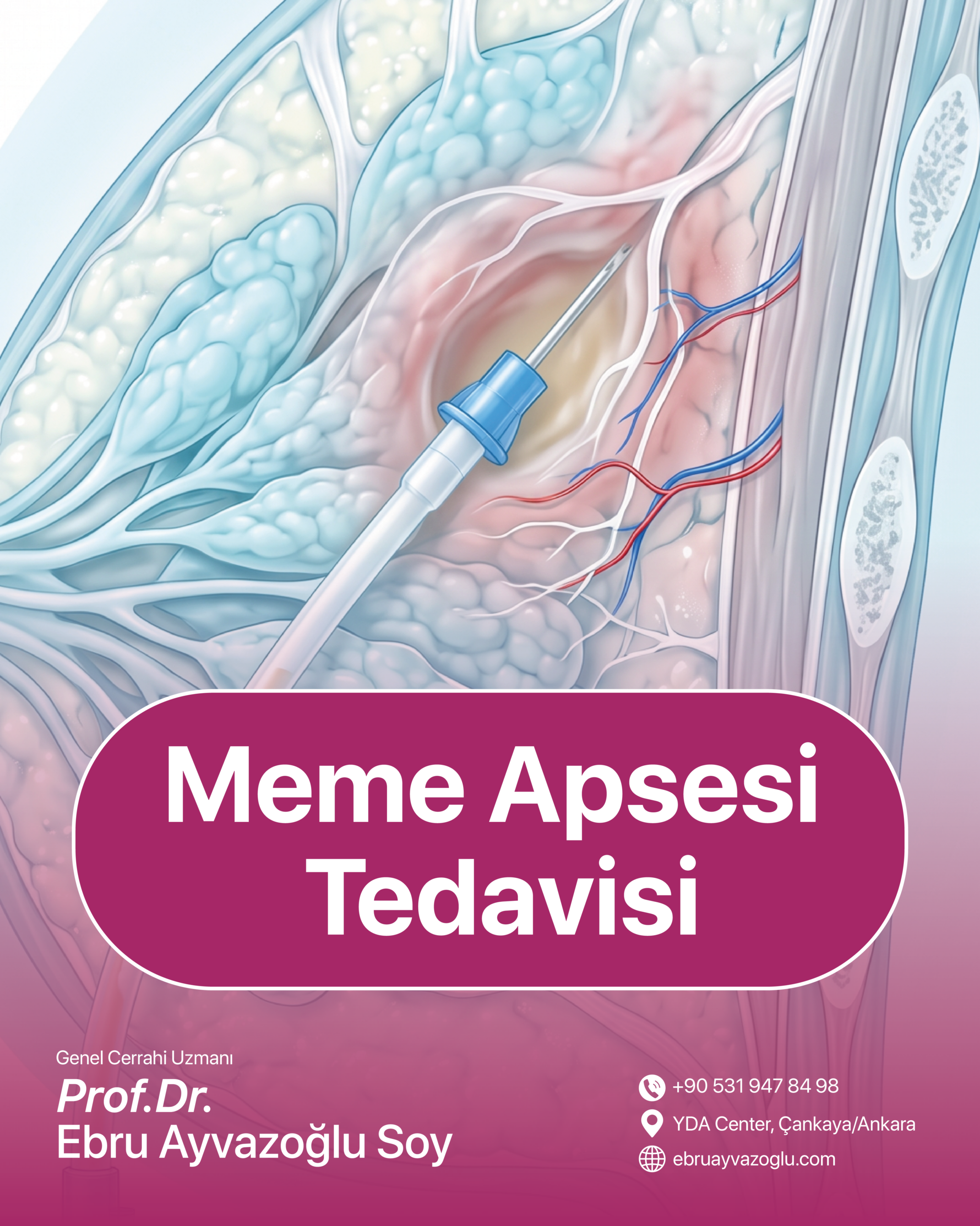 Meme Apsesi Tedavisi