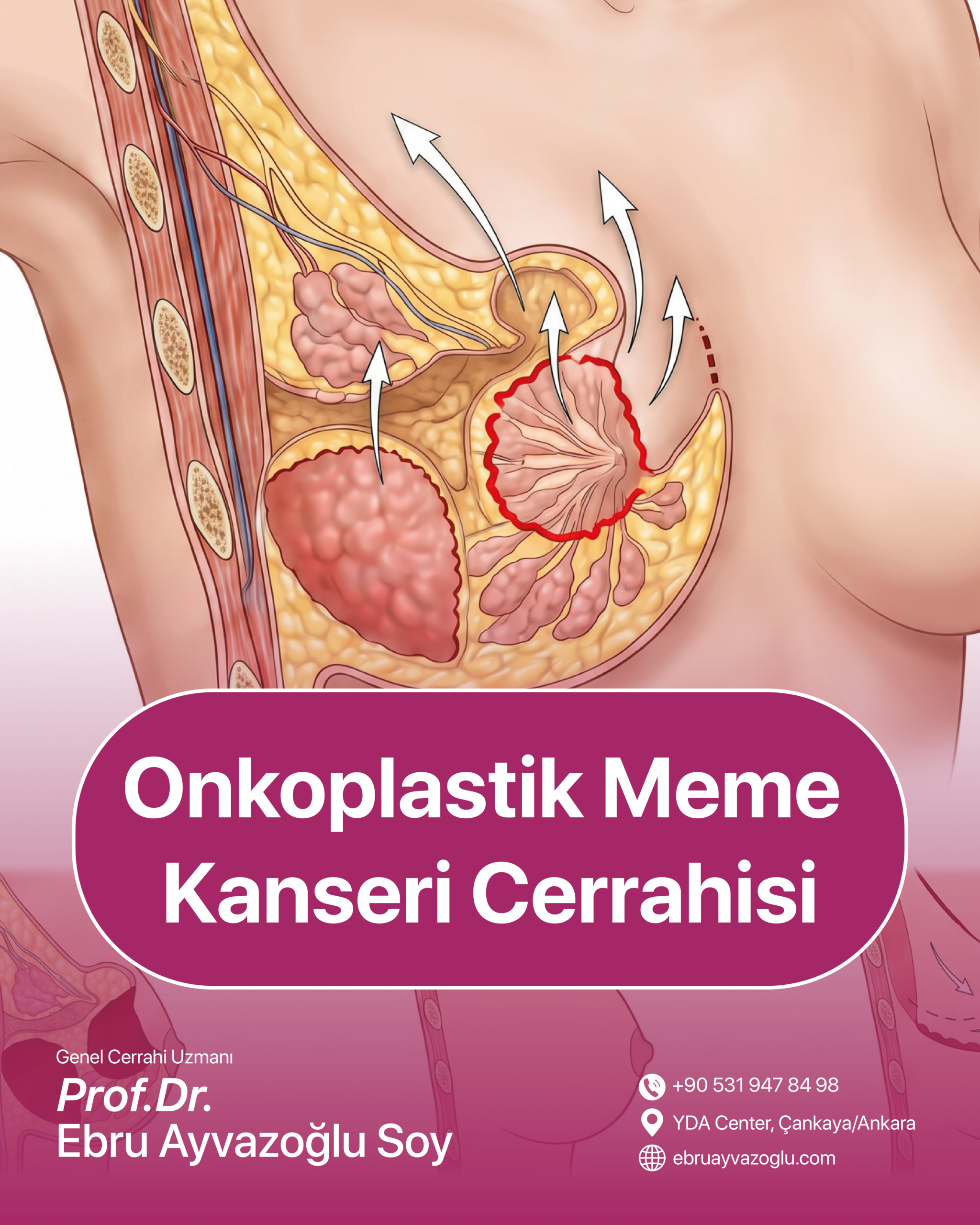 Onkoplastik Meme Kanseri Cerrahisi