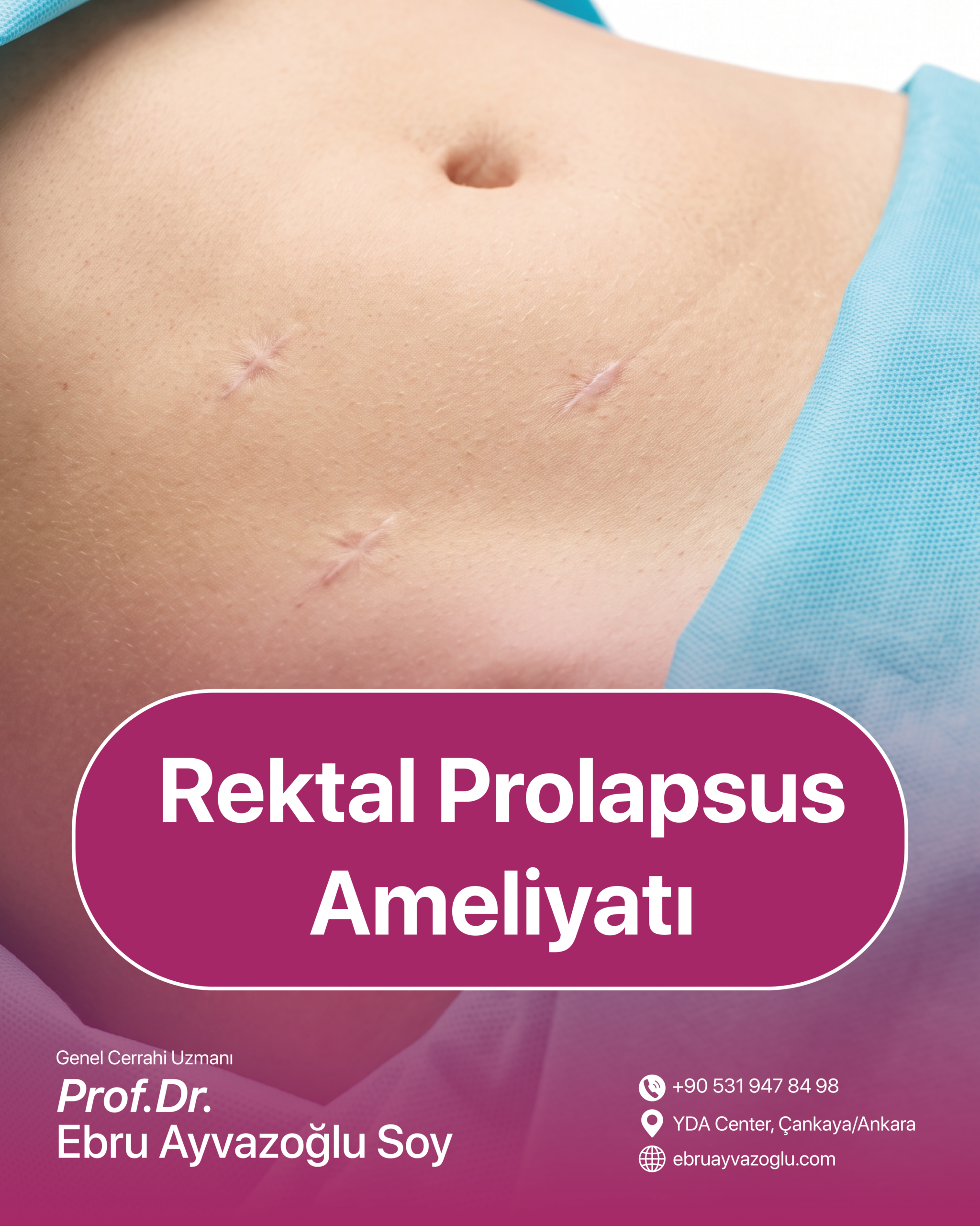 Rektal Prolapsus Ameliyatı